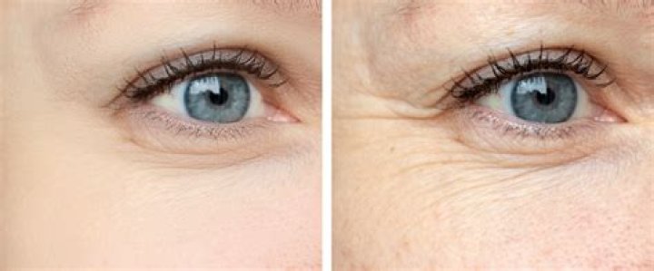 Are fillers safer than Botox?