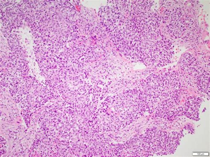 Does squamous cell carcinoma show up in bloodwork?