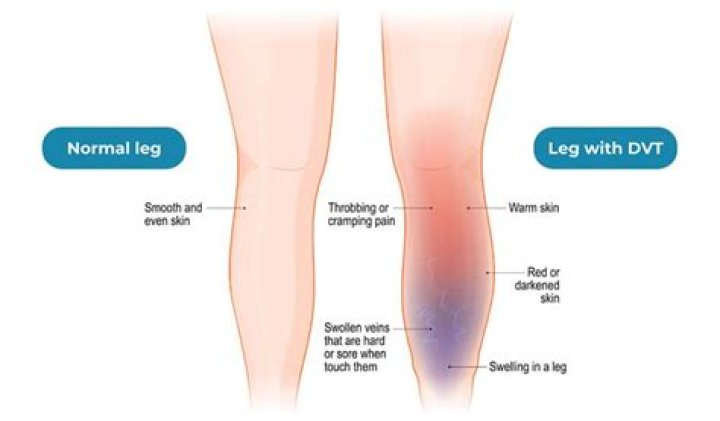 Does swelling from DVT come and go?