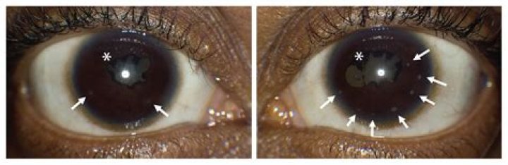 How does sarcoidosis affect the eyes?