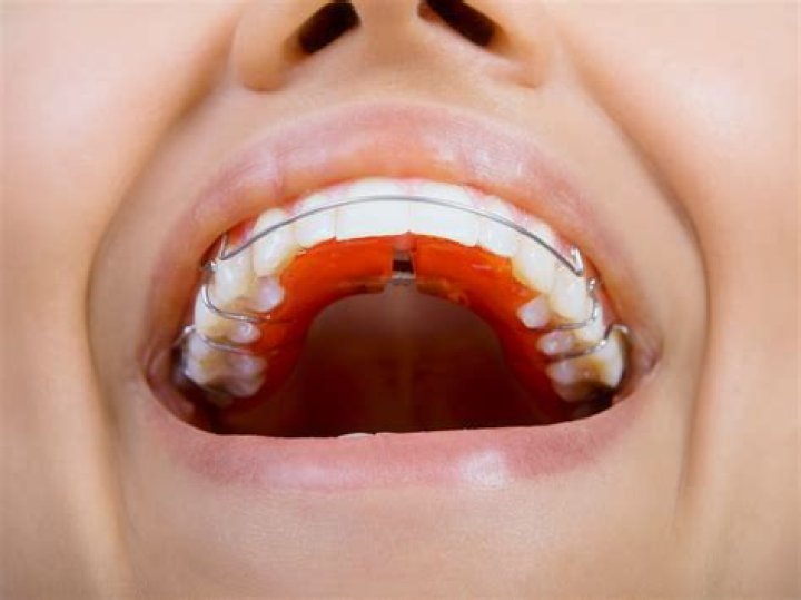 How long does a retainer last?