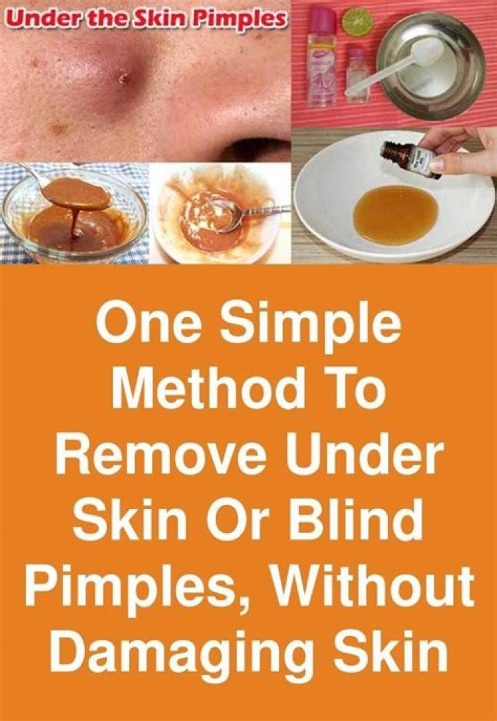 Should you ice or heat a blind pimple?
